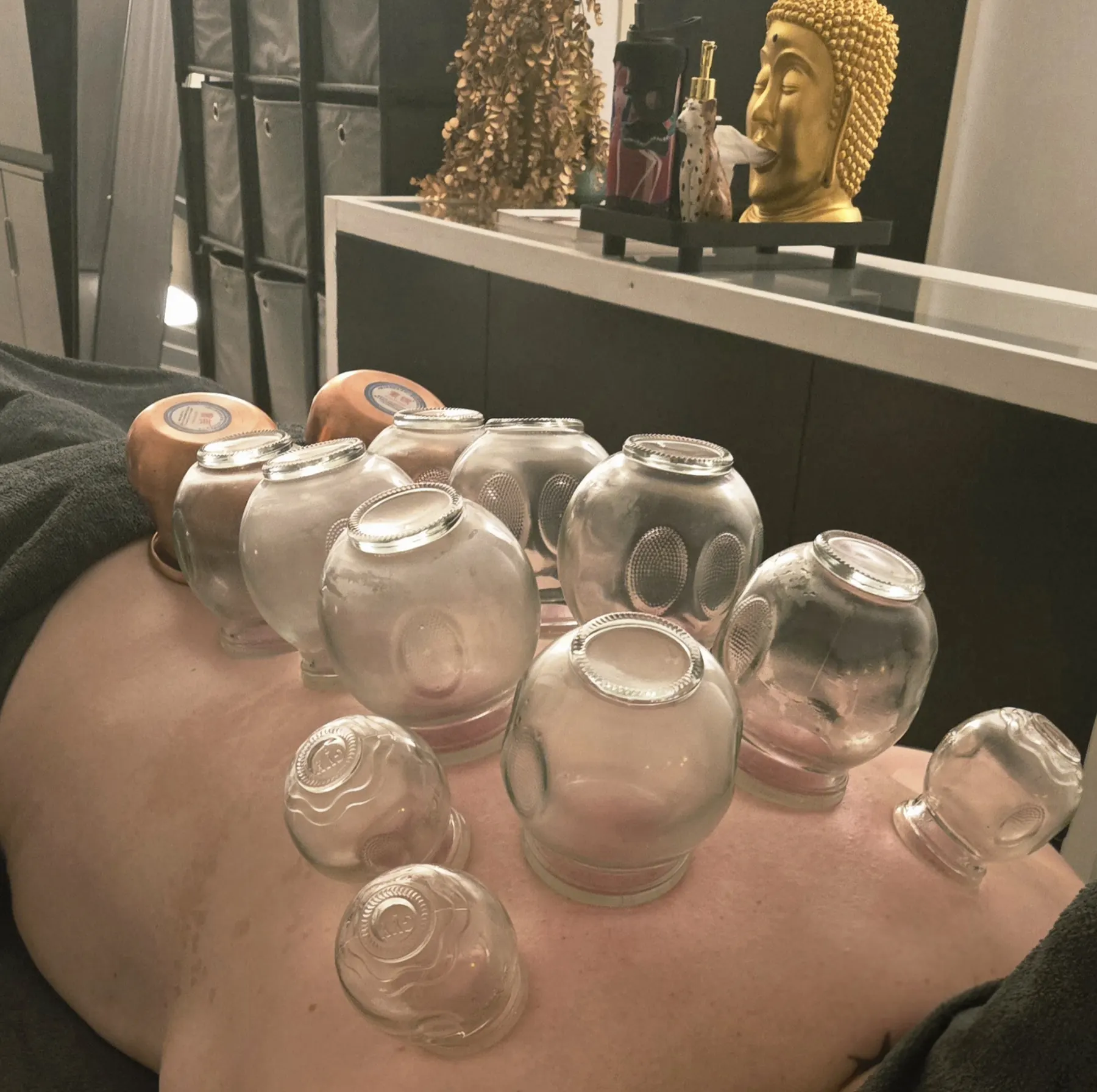 glazen cups op de rug tijdens een cupping-behandeling bij Massagepraktijk ALT Maastricht